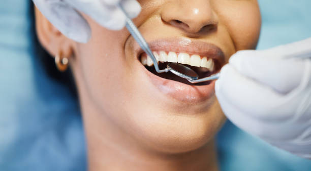 Teeth Whitening in MT
